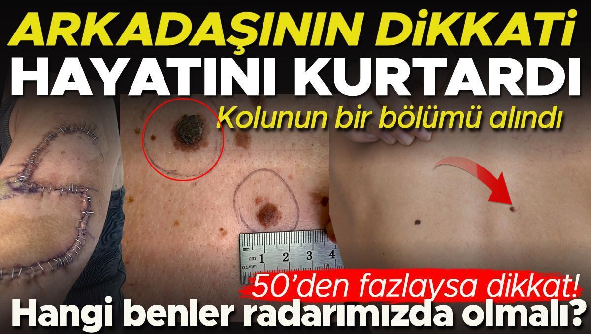 Arkadaşının dikkati sayesinde kanser olduğunu öğrendi, kolunun bir kısmı alındı | Hangi benler radarımızda olmalı?