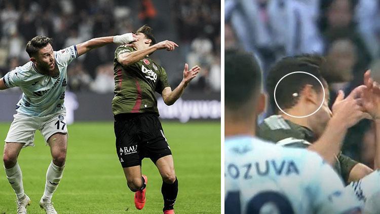Beşiktaş’ta sakatlıklar tat kaçırdı! Yıldız oyuncunun dişi kırıldı