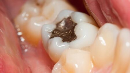 Metal dolgu ve implantı olanlar ondan uzak dursun