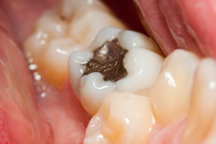 Metal dolgu ve implantı olanlar ondan uzak dursun
