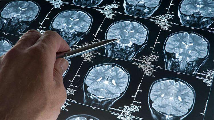 Alzheimer’da yeni umut: Erken evrede teşhisi mümkün kılacak kan testi ABD’de onaylandı