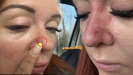 Sıradan bir sivilce sandı, ancak hayatı altüst oldu! Her yıl 2 binden fazla kişinin vefatına yol açıyor